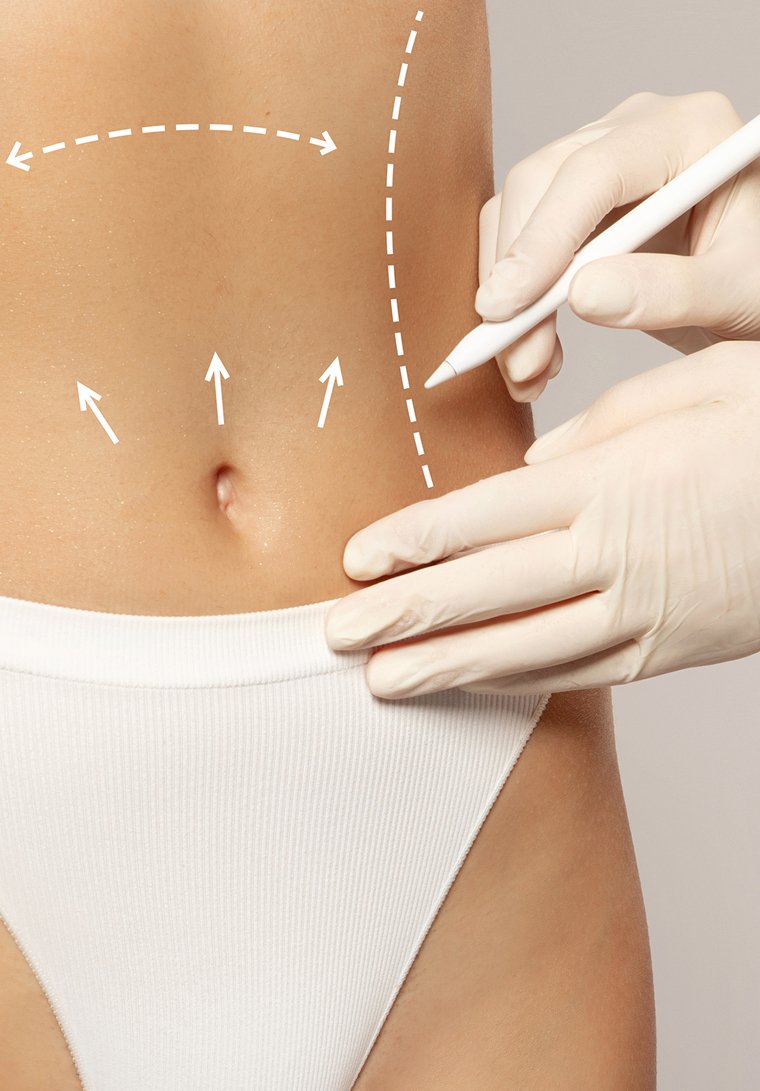 Liposuction